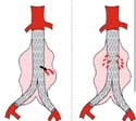 Hanks-Aortic-Stent 